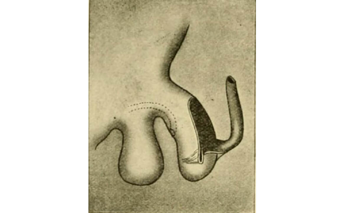Best Pediatric Urologist in India, Robotic pediatric urology